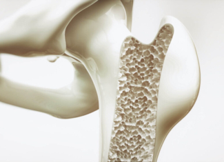 La importancia del tratamiento de la osteoporosis