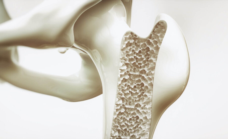 la-importancia-del-tratamiento-de-la-osteoporosis