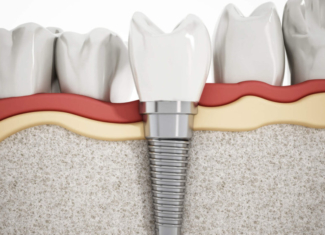 Soluciones innovadoras para implantes dentales con limitación ósea