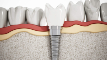 soluciones-innovadoras-para-implantes-dentales-con-limitacion-osea