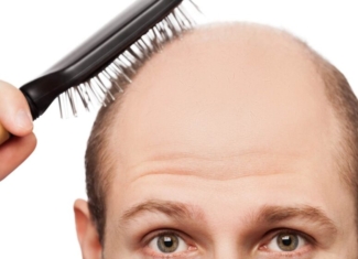 Así es el novedoso tratamiento para la alopecia androgénica o calvicie común