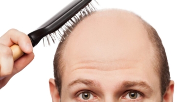asi-es-el-novedoso-tratamiento-para-la-alopecia-androgenica-o-calvicie-comun