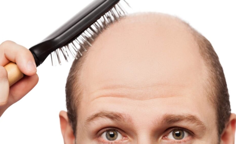 asi-es-el-novedoso-tratamiento-para-la-alopecia-androgenica-o-calvicie-comun