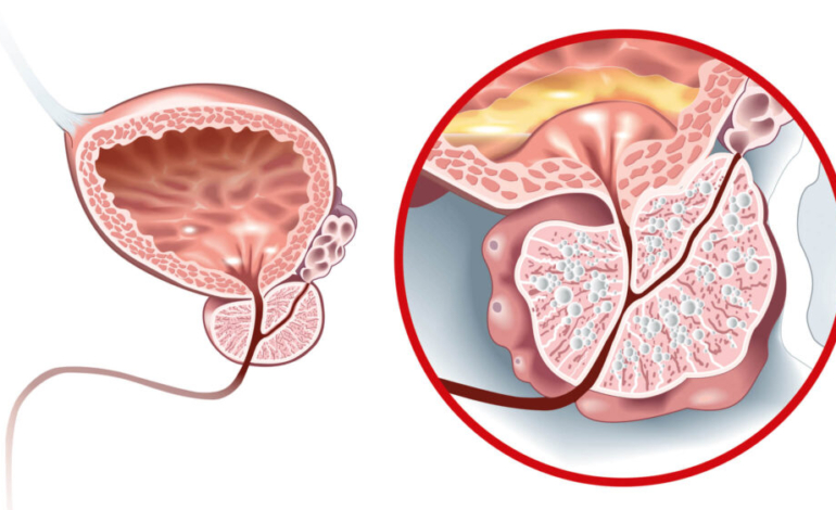 ¿existe-tratamiento-ambulatorio-para-la-hiperplasia-benigna-de-prostata?