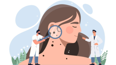 asi-combate-la-inmunoterapia-el-cancer-de-piel