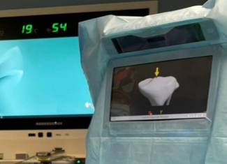 Así es la innovadora cirugía de prótesis de rodilla navegada