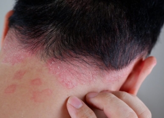 Fármacos que se activan con luz como tratamiento para la psoriasis