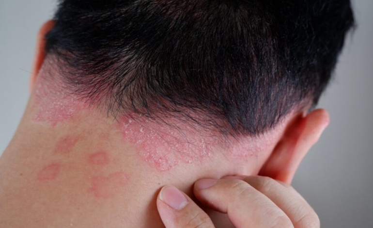 farmacos-que-se-activan-con-luz-como-tratamiento-para-la-psoriasis