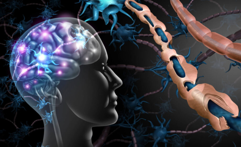 inteligencia-artificial-para-el-seguimiento-de-la-esclerosis-multiple