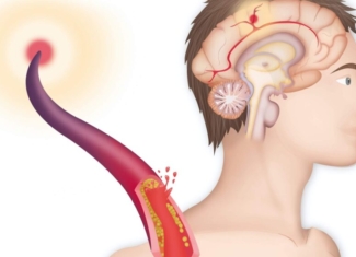 La molécula del organismo que reduce la inflamación y el daño cerebral tras un ictus