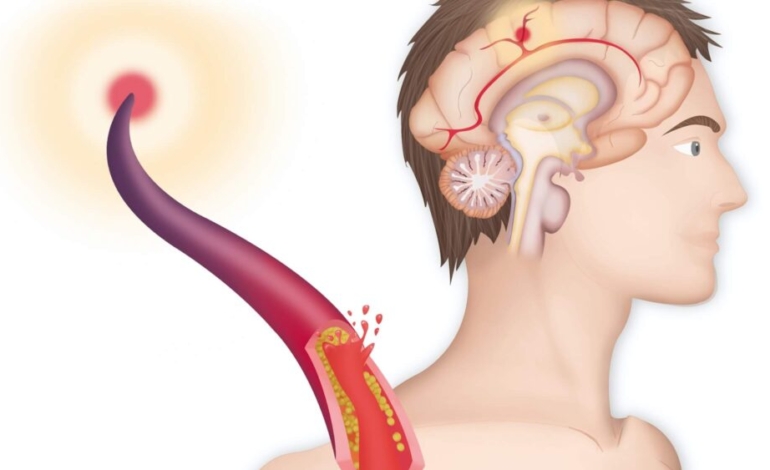 la-molecula-del-organismo-que-reduce-la-inflamacion-y-el-dano-cerebral-tras-un-ictus